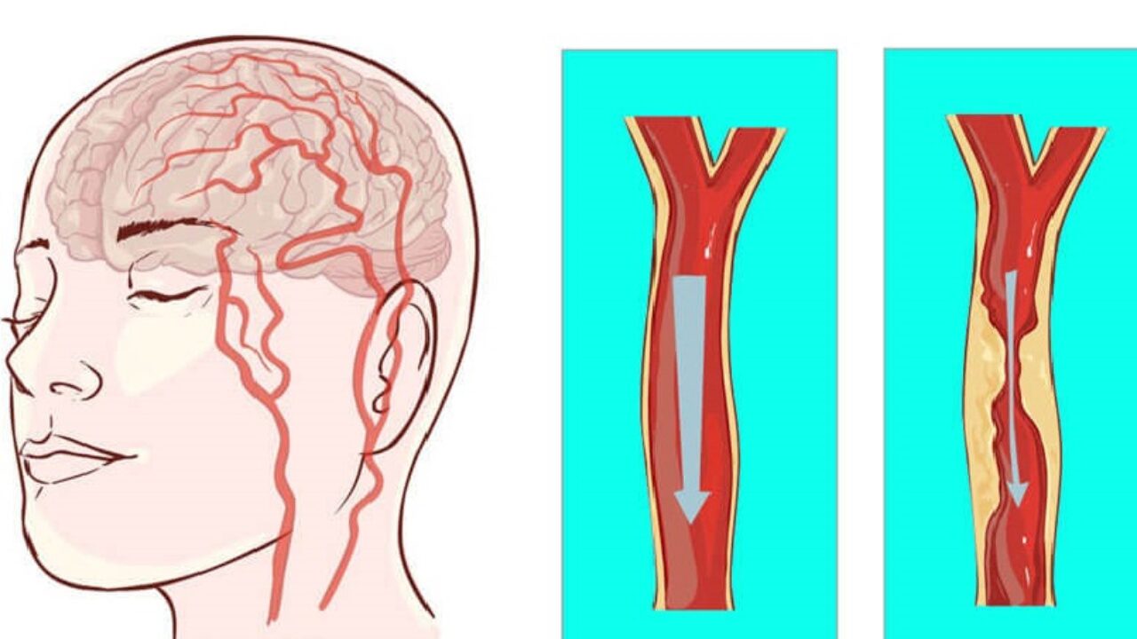 Инсульт левой артерии. Стеноз церебральных артерий. Сужение сосудов головного мозга.